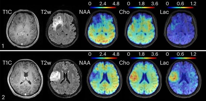 New MRI approach maps brain metabolism, revealing disease signatures