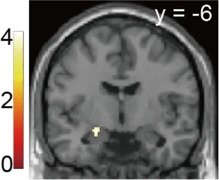 Figure 3 Amygdala activity reflecting valuation of feedback uncertainty.