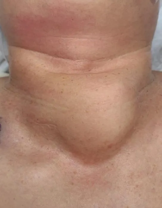 Thyroid cancer