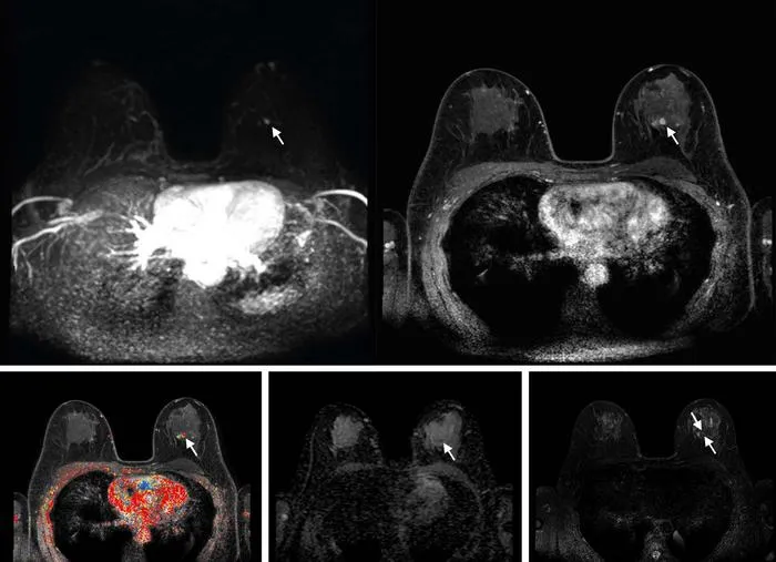 Abbreviated breast MRI images
