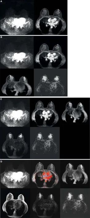 Breast MRI
