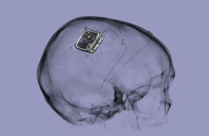 Picostim neurostimulator