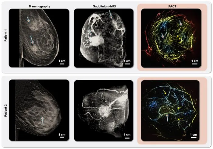 Mammography/MRI/PACT imaging of invasive ductal carcinoma