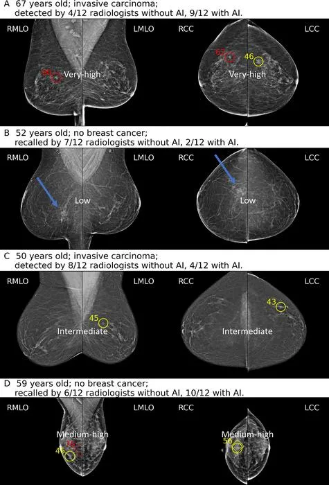 Screening Mammograms