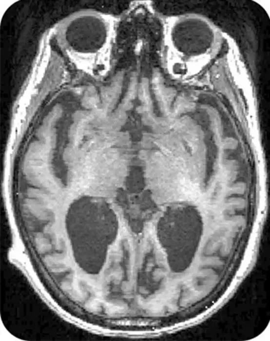 MRI brain scan of a patient progressing rapidly to Alzheimer’s disease.