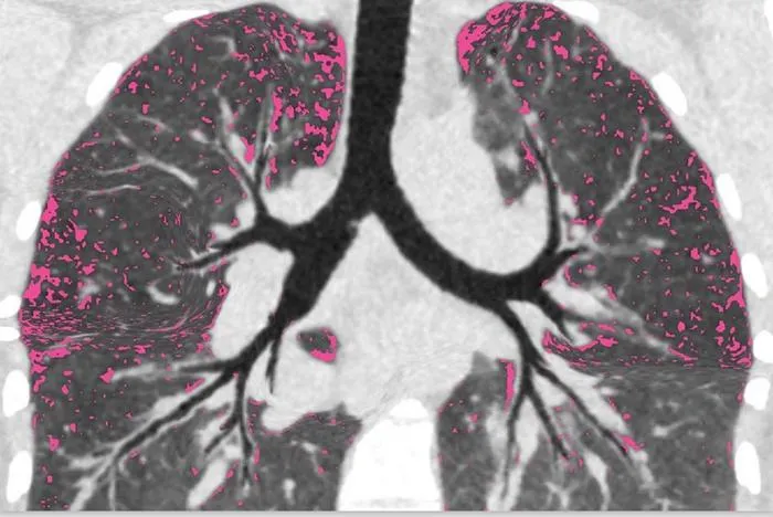Air trapping in lungs of cystic fibrosis patient treated with CFTR modulator.