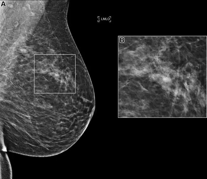 Left mediolateral oblique mammogram in a 58-year-old woman