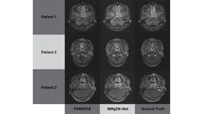 A progressive evolution in virtual MRI imaging for tumour detection