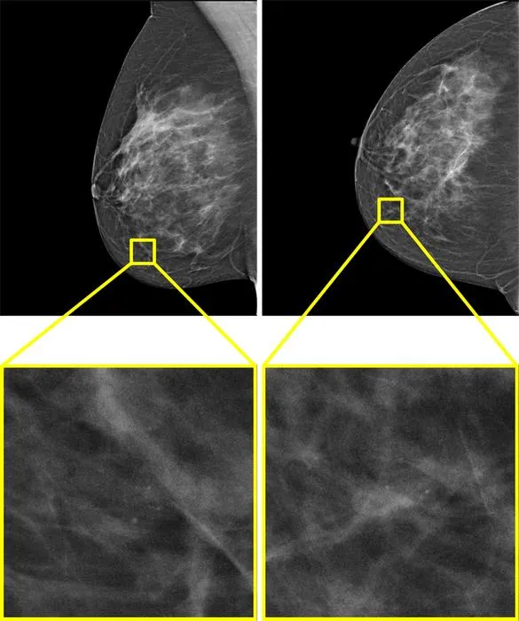 Example of a screening examination with a screen-detected cancer that would have been missed by AI