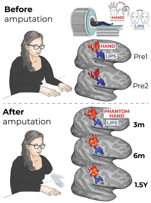 Brain activity maps for the hand and lips before and after amputation