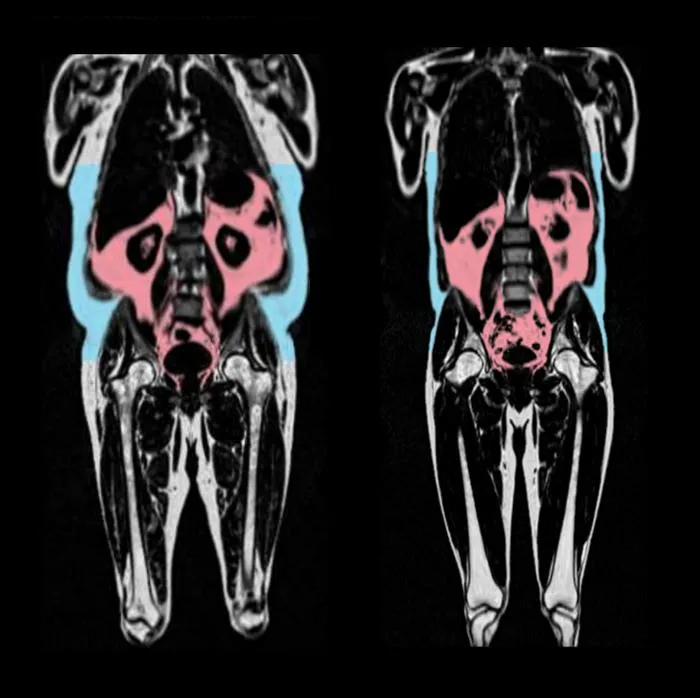 Body fat on MRI