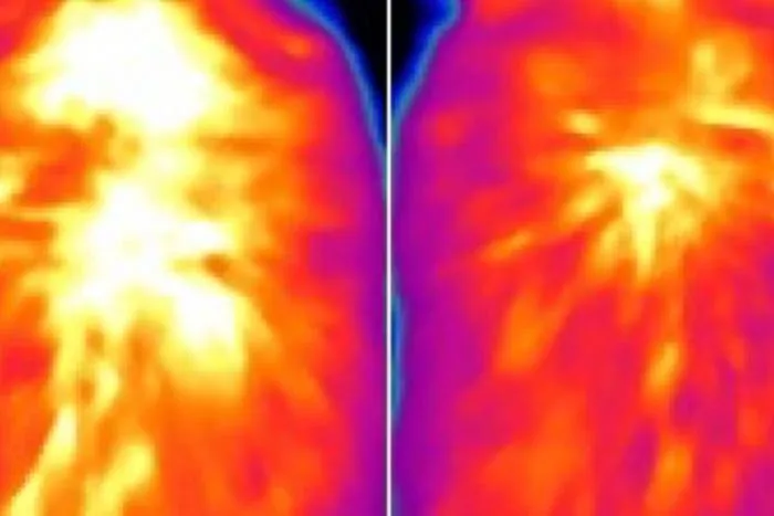 Novel way to ‘rev up’ brown fat burns calories, limits obesity in mice