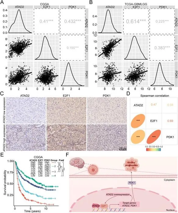 The clinical significance of the ATAD2-E2F1-PDK1 axis in glioma