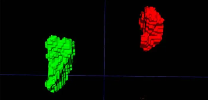Left and right adrenal automated 3D segmentation in chest CT.