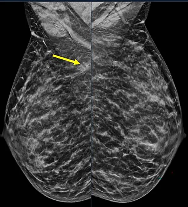Extremely dense breast tissue is noted on mammography