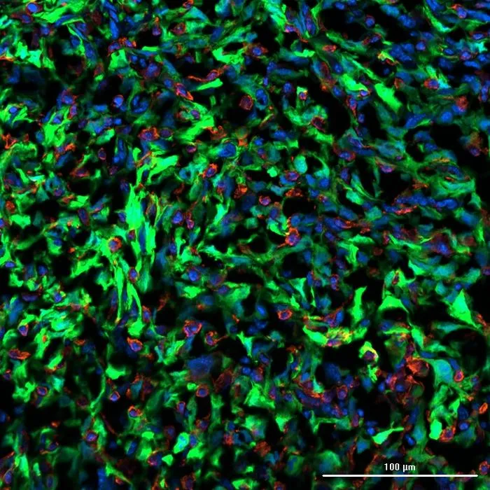 Cancer cells (marked in green) communicate with astrocytic cells (marked in red) in the brain to utilize building blocks secreted by the astrocytes. (Cell nuclei are marked in blue.)