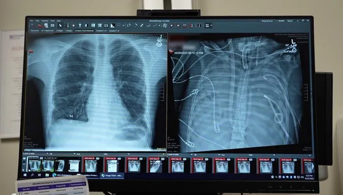 The patients’ new lungs (left) and old lungs (right).