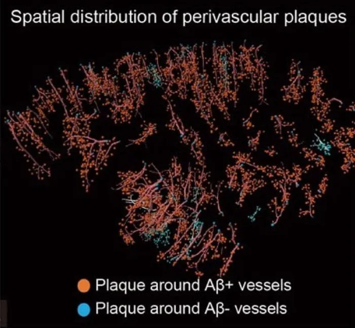 Reconstructed perivascular senile plaques around Aβ-positive/negative vessels.