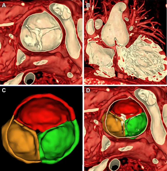 Cardiac MRI in a 5-year-old female patient with neoaortic insufficiency