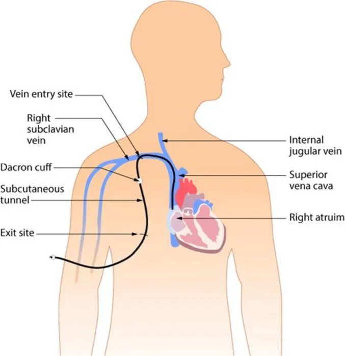 Positions of catheter insertion affect infection rates