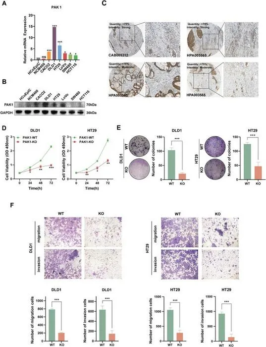 PAK1 deficiency inhibits CRC progression