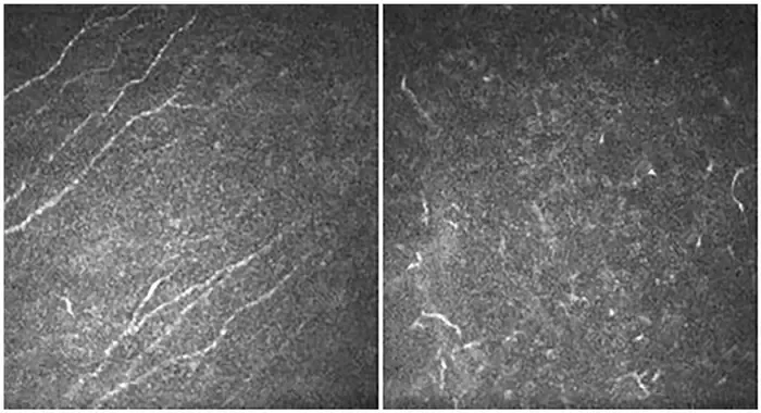 The rare disease aniridia causes a progressive loss of corneal sensitivity