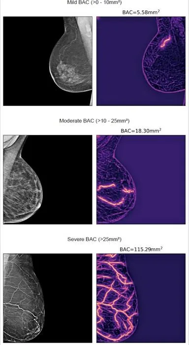 Mammograms showing calcification