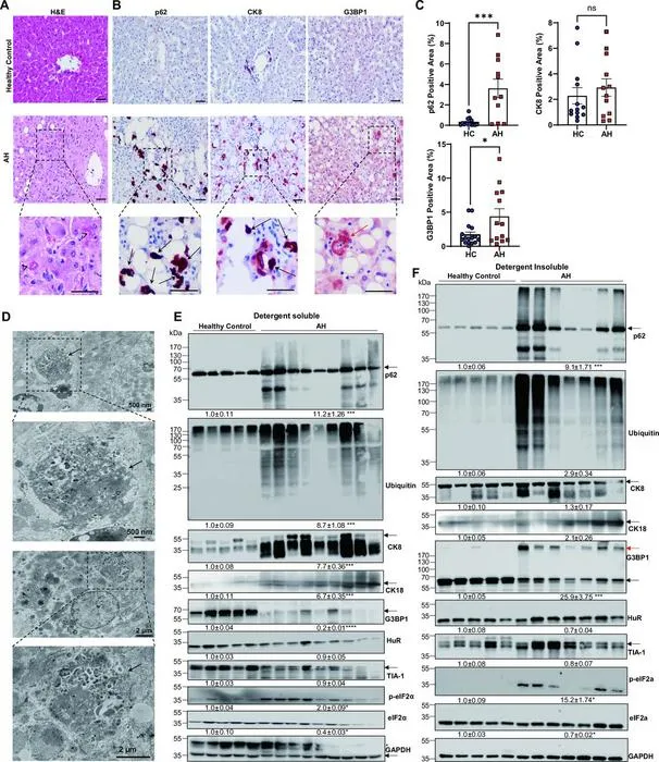 Increased p62, CK8 and G3BP1 protein aggregation in patients with AH.