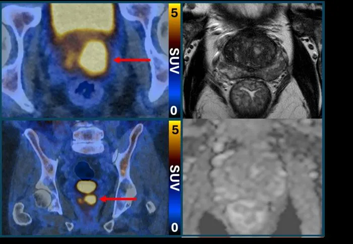 PRIMARY2 PSMA PET/CT vs MRI