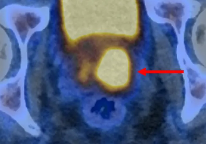 Glowing prostate cancer cells PSMA PET/CT 1