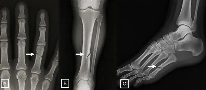 Examples of GPT-4o-generated X-rays of fractures