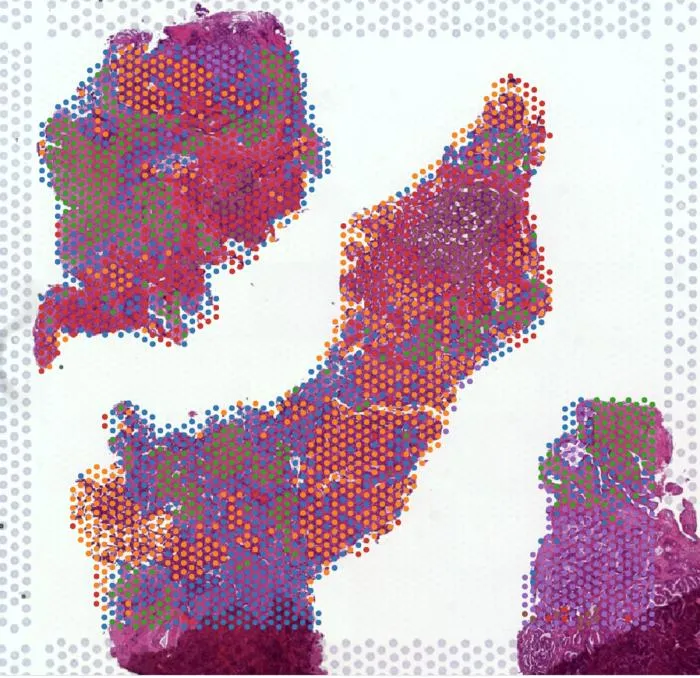 Spatial mapping reveals the complex cellular landscape of prostate tumours.