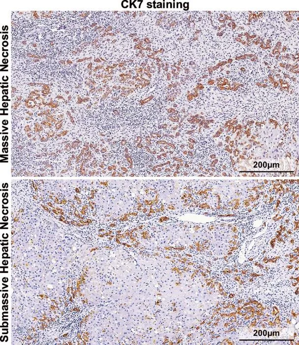 MHN and SMHN are observed in two patients with acute liver failure associated with HBV infection.