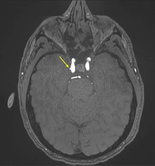 MR angiography image in a 39-year-old male shows a laterally projecting intracranial aneurysm