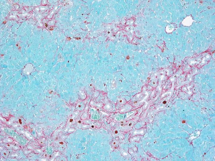 Fibrosis in parenchymal liver cells