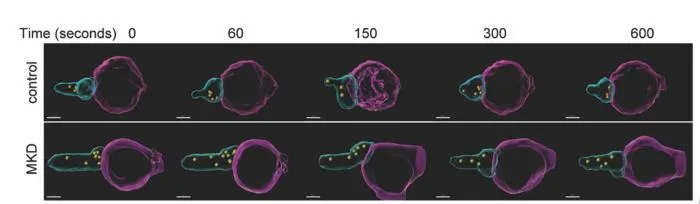 3D video frames of an MKD patient's impaired NK cells
