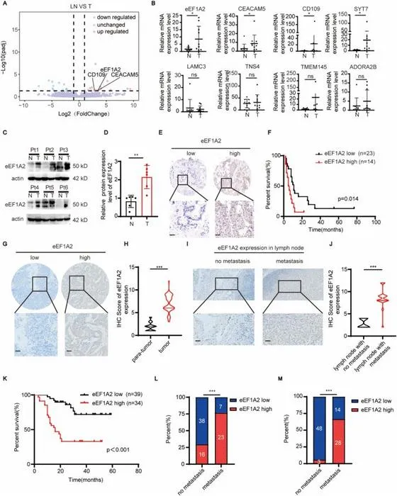 eEF1A2 is tightly correlated with lymph node metastasis and poor prognosis in patients with GBC.