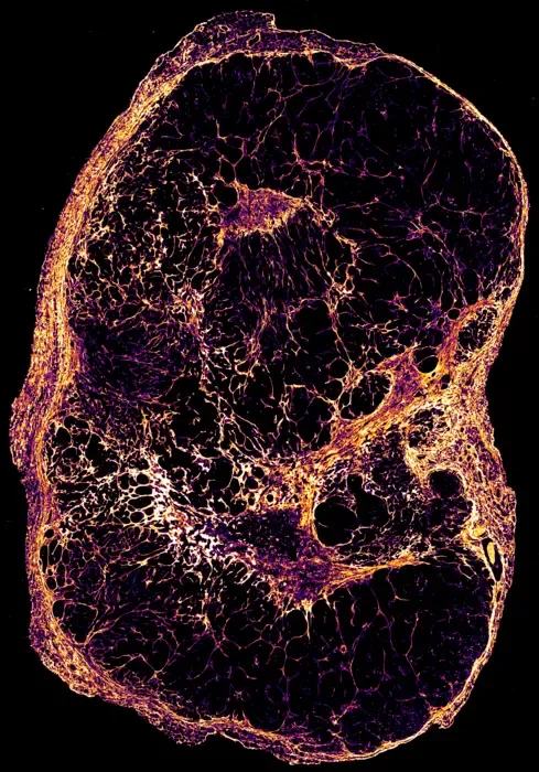 Microscopy of a slow-growing breast cancer tumour