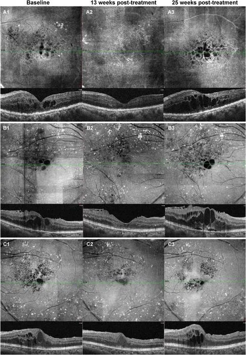 Recurrence of DME was observed in the OCTA en-face and B-scan images of three eyes from the “3 + PRN” group.
