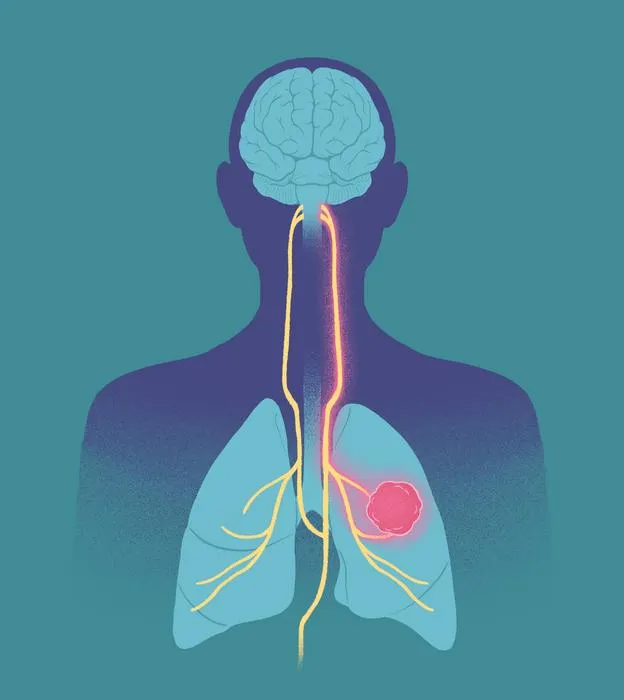 Lung cancer to brain superhighway illustration