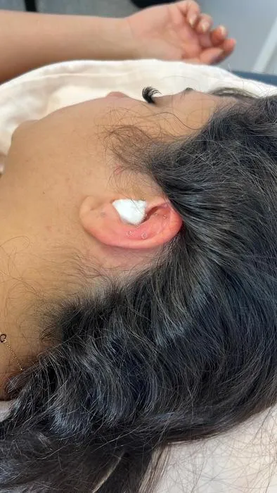 Could acupuncture to the ear help to relieve migraines?