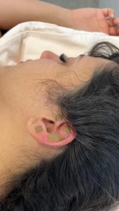 Could acupuncture to the ear help to relieve migraines?