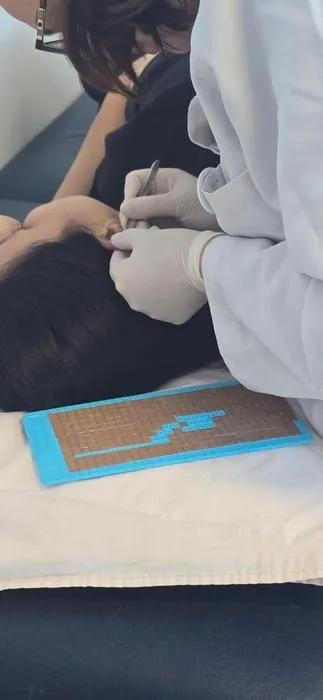 Could acupuncture to the ear help to relieve migraines?