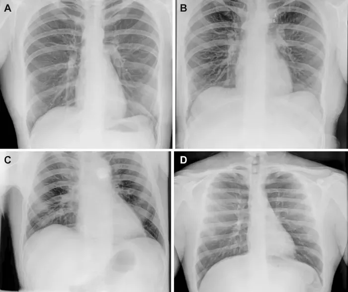 Preflight, in-flight, and postflight chest X-rays