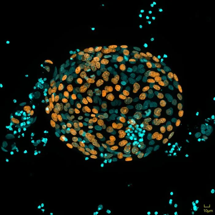 Chronic pancreatitis organoids