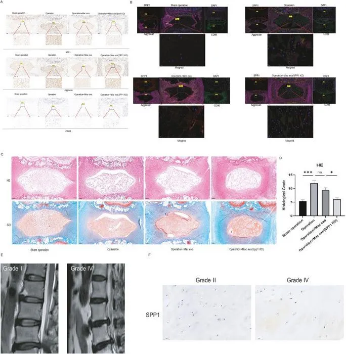 In vivo validation of SPP1-knockdown exosomes and human tissue analysis