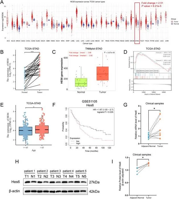 The expression of Hes6 is frequently up-regulated in tumor tissues of human gastric cancer (GC), and is associated with prognosis