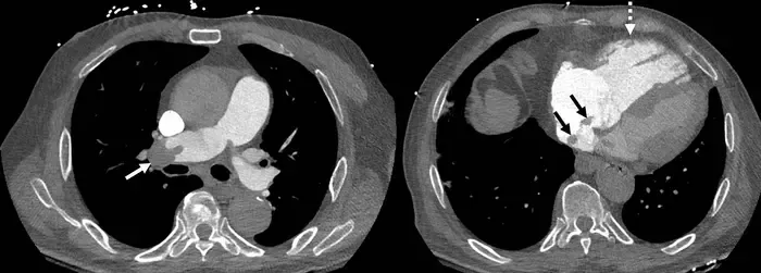Acute pulmonary embolism with right ventricle enlargement and clot-in-transit