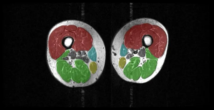 MRI image of thigh muscle