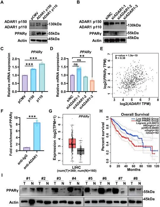 ADAR1 promotes liver cancer progression via post-transcriptional regulation of PPARγ